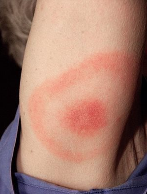 'Bulls eye' rash from Lyme disease